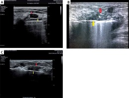 https://www.archivesofmedicalscience.com/f/fulltexts/106200/AMS-18-2-106200-g003_min.jpg