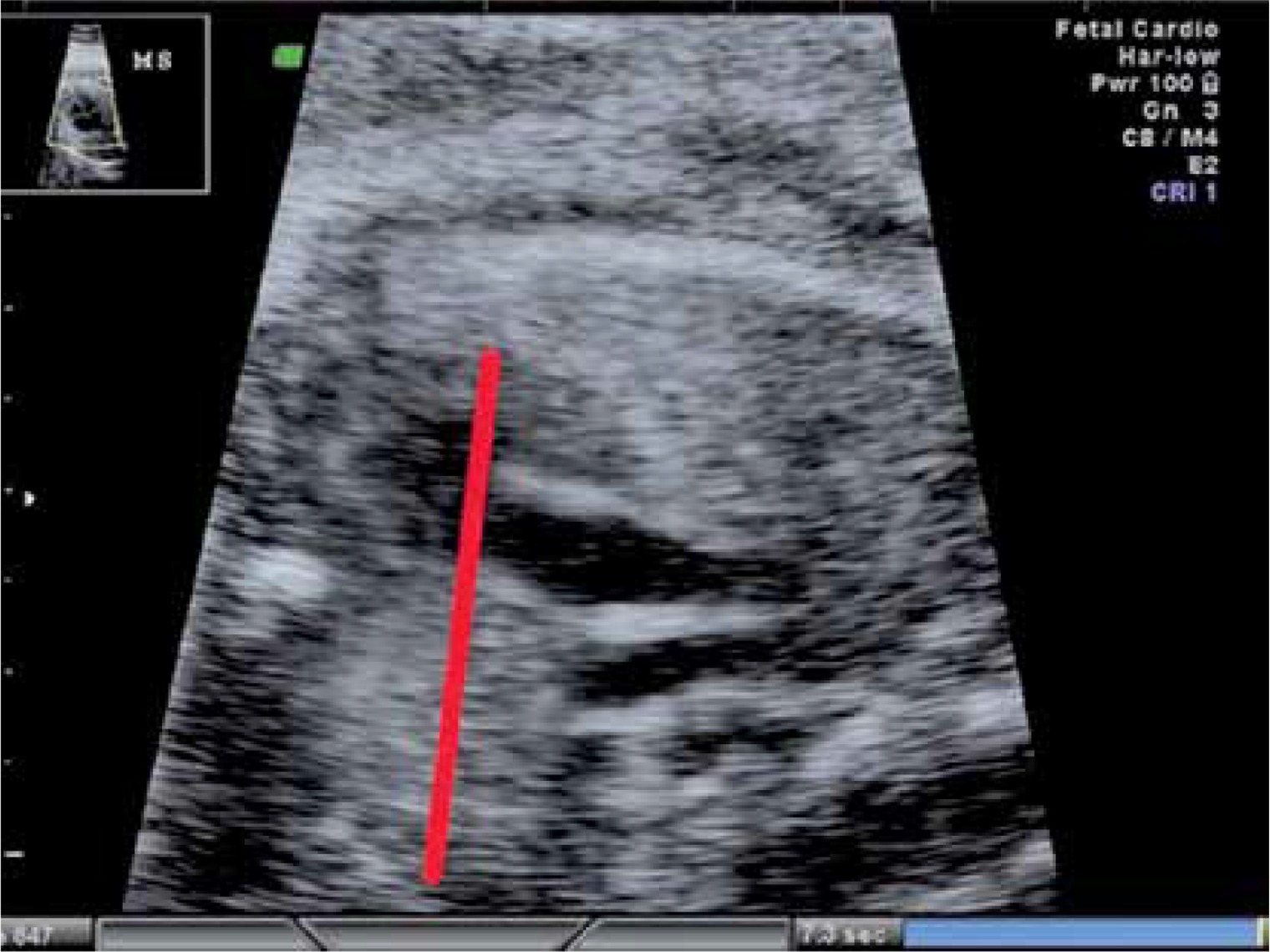 Ultrasound gestational age measurements chart