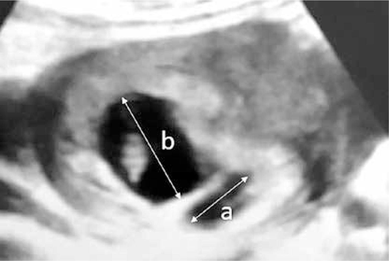 Subchorionic Hemorrhage Size Chart