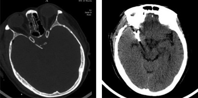 https://www.archivesofmedicalscience.com/f/fulltexts/122492/AMS-22-1-122492-g003_min.jpg