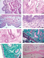 https://www.archivesofmedicalscience.com/f/fulltexts/123936/AMS-22-1-123936-g003_min.jpg