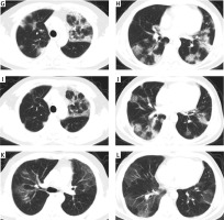 https://www.archivesofmedicalscience.com/f/fulltexts/126006/AMS-22-4-126006-g001_min.jpg