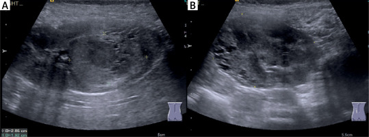https://www.archivesofmedicalscience.com/f/fulltexts/126284/AMS-22-3-126284-g001_min.jpg