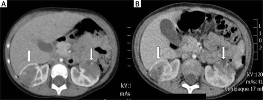 https://www.archivesofmedicalscience.com/f/fulltexts/126284/AMS-22-3-126284-g002_min.jpg