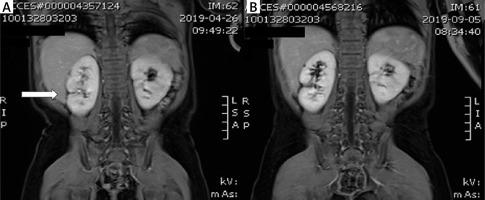 https://www.archivesofmedicalscience.com/f/fulltexts/126284/AMS-22-3-126284-g003_min.jpg