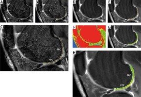 https://www.archivesofmedicalscience.com/f/fulltexts/140714/AMS-18-4-140714-g001_min.jpg