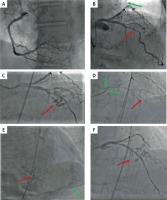 https://www.archivesofmedicalscience.com/f/fulltexts/143151/AMS-17-6-143151-g001_min.jpg