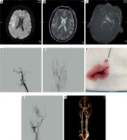 https://www.archivesofmedicalscience.com/f/fulltexts/143513/AMS-17-6-143513-g001_min.jpg