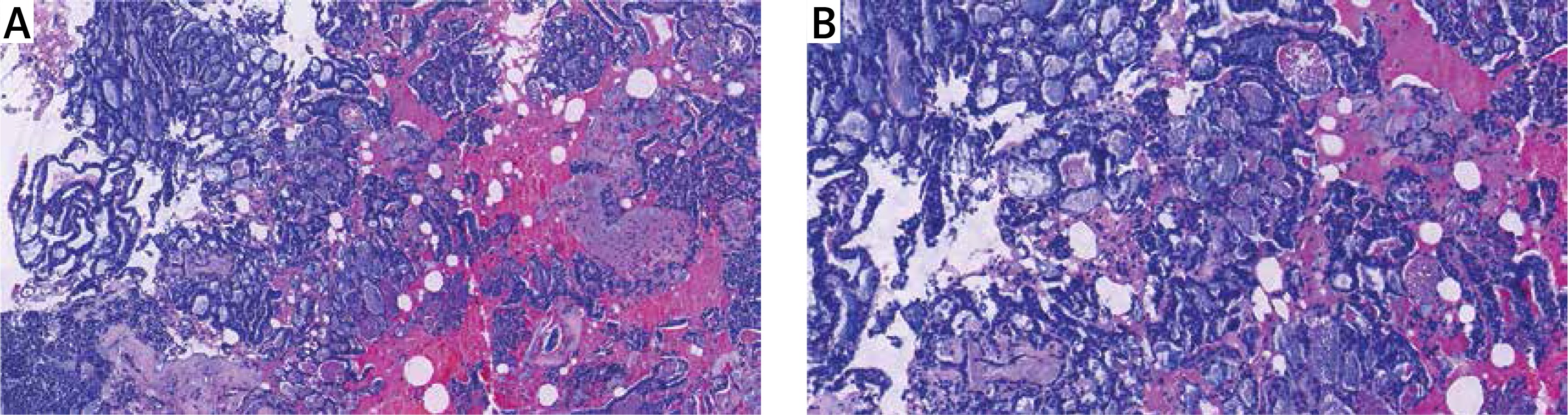 Diagnosis Of Adenoid Cystic Carcinoma In The Breast A Case Report And