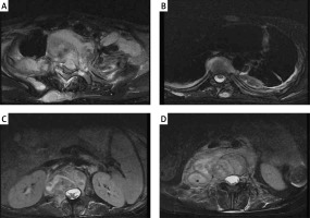 https://www.archivesofmedicalscience.com/f/fulltexts/148090/AMS-18-3-148090-g001_min.jpg