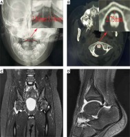 https://www.archivesofmedicalscience.com/f/fulltexts/148123/AMS-18-3-148123-g001_min.jpg