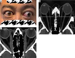 https://www.archivesofmedicalscience.com/f/fulltexts/153478/AMS-18-6-153478-g001_min.jpg