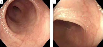 https://www.archivesofmedicalscience.com/f/fulltexts/155185/AMS-18-6-155185-g003_min.jpg