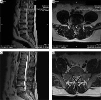 https://www.archivesofmedicalscience.com/f/fulltexts/165859/AMS-19-4-165859-g003_min.jpg