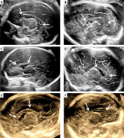 https://www.archivesofmedicalscience.com/f/fulltexts/178184/AMS-21-4-178184-g005_min.jpg
