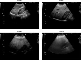 https://www.archivesofmedicalscience.com/f/fulltexts/193393/AMS-21-3-193393-g002_min.jpg