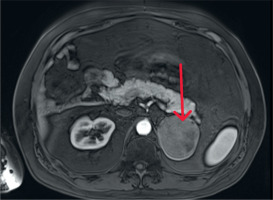 https://www.archivesofmedicalscience.com/f/fulltexts/207059/AMS-21-3-207059-g003_min.jpg