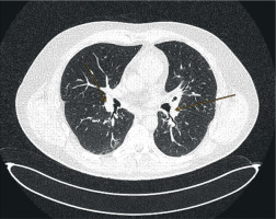 https://www.archivesofmedicalscience.com/f/fulltexts/207059/AMS-21-3-207059-g004_min.jpg