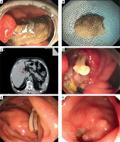 https://www.archivesofmedicalscience.com/f/fulltexts/207960/AMS-21-3-207960-g001_min.jpg