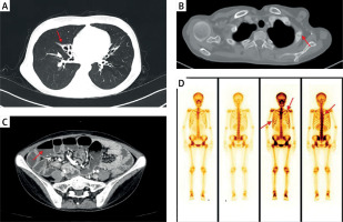 https://www.archivesofmedicalscience.com/f/fulltexts/209621/AMS-21-4-209621-g001_min.jpg