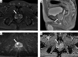 https://www.archivesofmedicalscience.com/f/fulltexts/213307/AMS-22-2-213307-g001_min.jpg