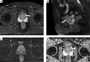 https://www.archivesofmedicalscience.com/f/fulltexts/213307/AMS-22-2-213307-g002_min.jpg
