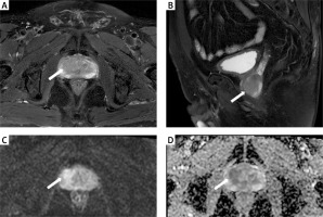https://www.archivesofmedicalscience.com/f/fulltexts/213307/AMS-22-2-213307-g003_min.jpg