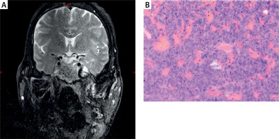 https://www.archivesofmedicalscience.com/f/fulltexts/224312/AMS-22-3-224312-g001_min.jpg