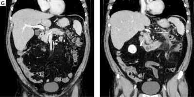 https://www.archivesofmedicalscience.com/f/fulltexts/77900/AMS-16-2-30799-g001c_min.jpg