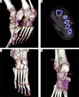 https://www.archivesofmedicalscience.com/f/fulltexts/89835/AMS-17-1-89835-g001_min.jpg