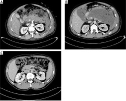 https://www.archivesofmedicalscience.com/f/fulltexts/89951/AMS-15-32744-g001_min.jpg