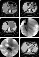 https://www.archivesofmedicalscience.com/f/fulltexts/89951/AMS-15-32744-g002_min.jpg