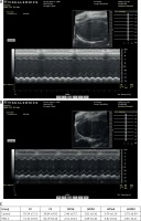 https://www.archivesofmedicalscience.com/f/fulltexts/91876/AMS-15-34572-g006_min.jpg