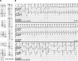 https://www.archivesofmedicalscience.com/f/fulltexts/91893/AMS-16-2-38578-g001_min.jpg