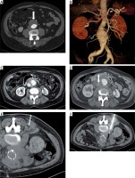 https://www.archivesofmedicalscience.com/f/fulltexts/95257/AMS-15-34134-g001_min.jpg