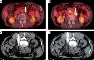 https://www.archivesofmedicalscience.com/f/fulltexts/95257/AMS-15-34134-g003_min.jpg