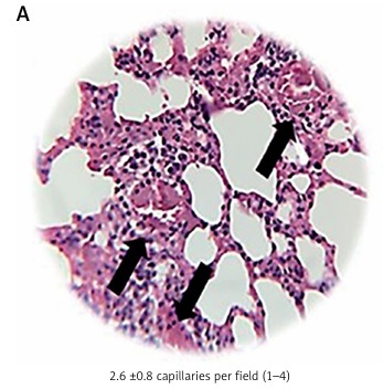 Hyperbaric oxygen effects on the alveoli-capillary unit in a murine model of pulmonary arterial hypertension