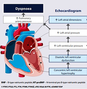 Left ventricular hypertrophy - Symptoms and causes - Mayo Clinic