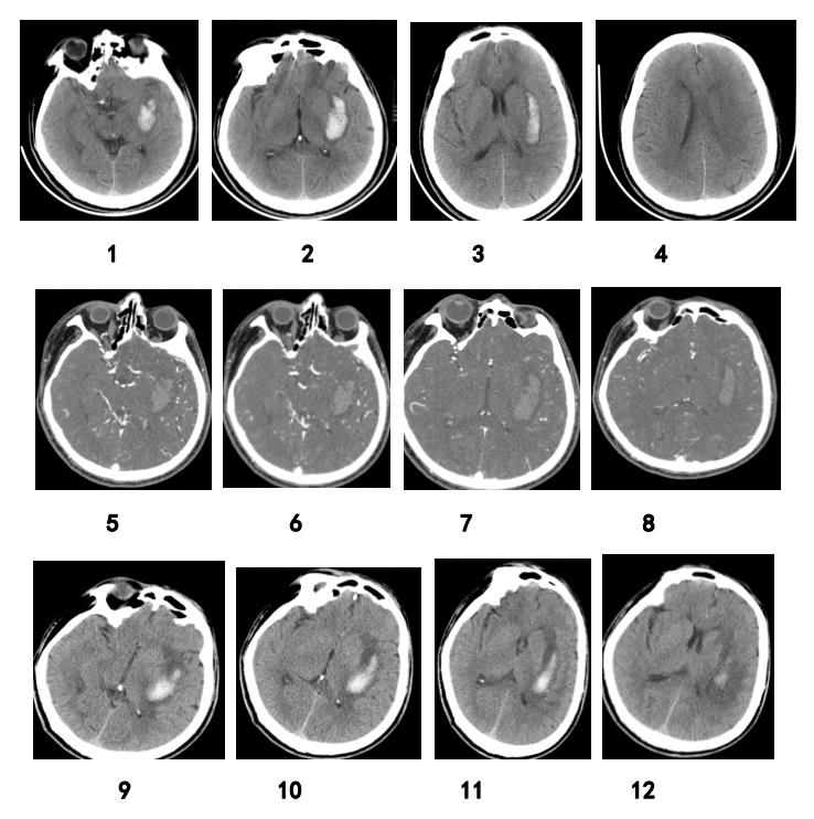 Predictive value of imaging manifestations of supratentorial hemorrhage ...