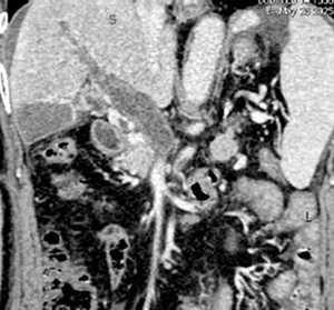Figure from article: Acute portal vein...