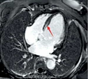 Figure from article: Pathogenic LMNA variant...