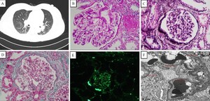 Figure from article: Focal segmental...
