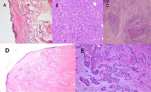 Figure from article: Orbital-sinonasal interface...