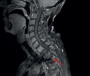 Figure from article: Teclistamab for...