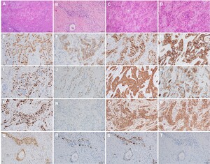 Figure from article: Primary renal parenchymal...
